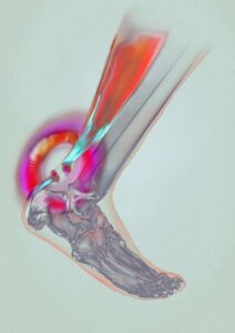 Achilles Tendonitis