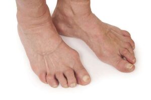 Arthritis 51598