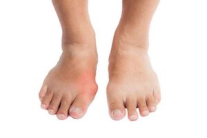 Arthritis