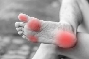 Arthritis
