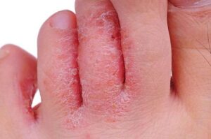 Athletes Foot 1