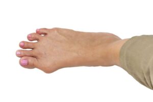 Bunions 1