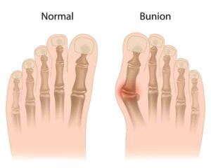 Bunions 3