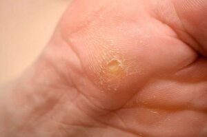Calluses 1