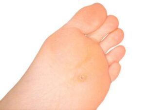 Calluses 2