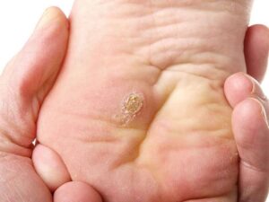 Calluses 4