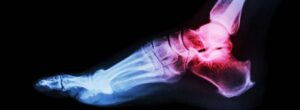 Foot Arthritis