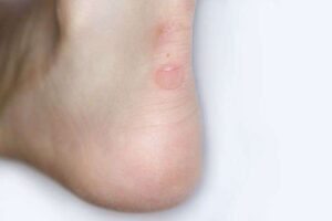 Friction Blisters
