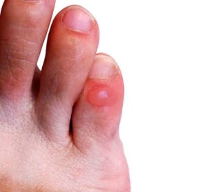 Friction Blisters 3 Frictions Blisters 5