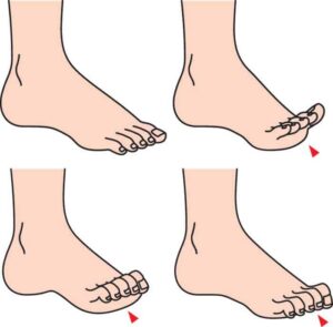 Hammertoes 1