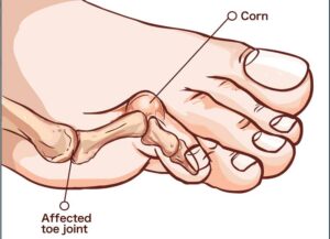 Hammertoes