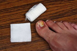 Ingrown Toe Nails 1