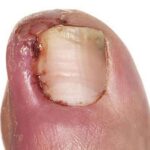 Ingrown Toe Nails 3 e1536068390843