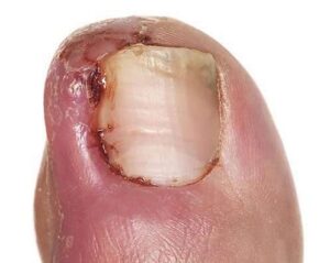 Ingrown Toe Nails 3 e1536068390843