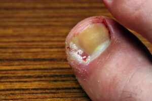 Ingrown Toe Nails 4