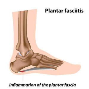 Plantar Fascitiis 3