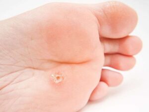 A Verruca That Won't Go Away? It Might Be A Corn 1 Verruca on Foot