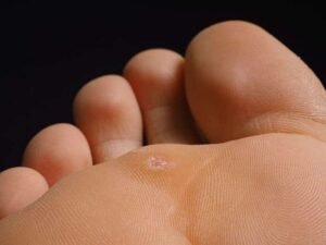 Verruca On Toe
