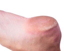 Heel Fissures