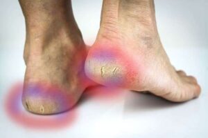 Heel Fissures 1 Heel Fissures