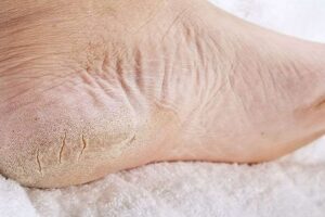 Heel Fissures 5