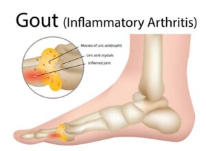 How Gout Affects Your Feet