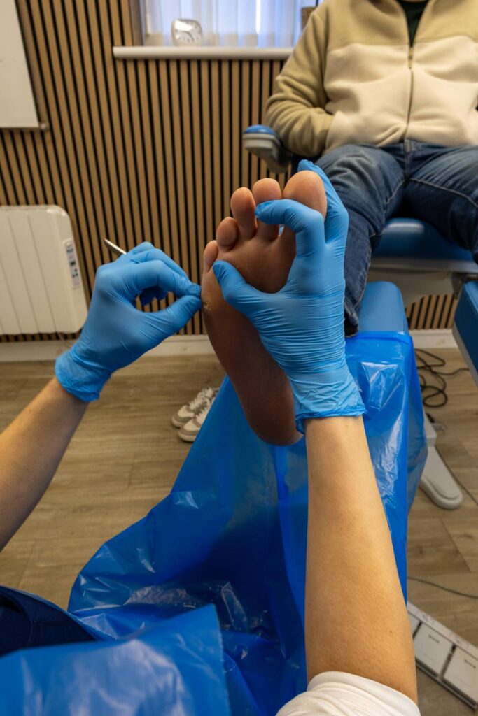Callus debridement (1)